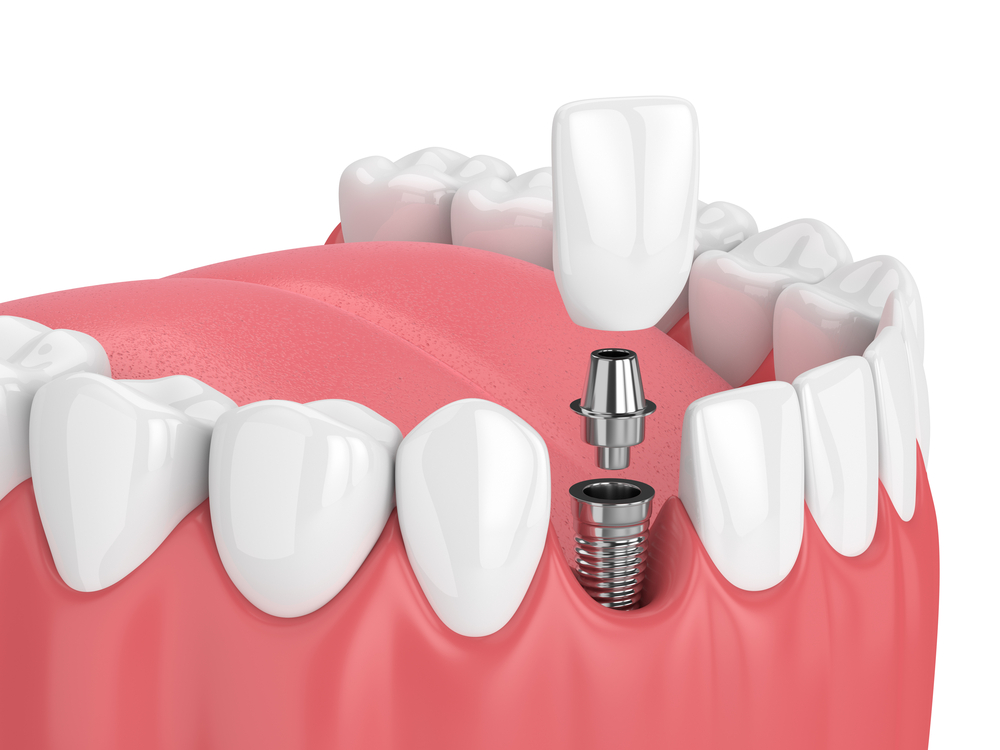 3d render of jaw with teeth of Ramsey dental implants.