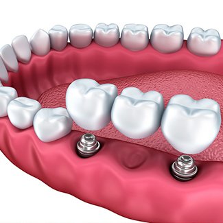 3D model of Ramsey dental bridges