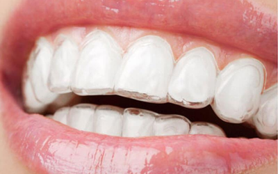 Clear braces for adults | Modern Orthodontic Solutions