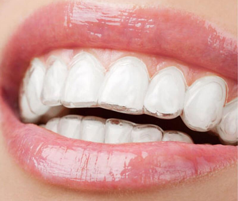 Clear braces for adults | Modern Orthodontic Solutions