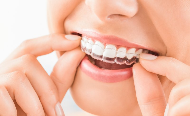 How long does Invisalign take